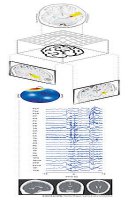 Software localiza focos epilepticos